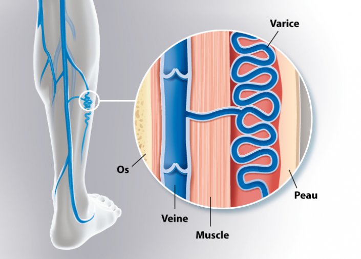 varicoza i osteopatie)